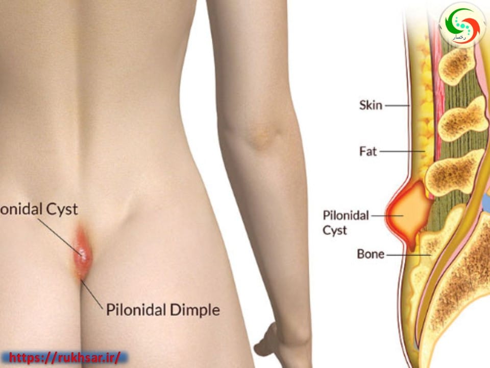 عکس کیست مویی