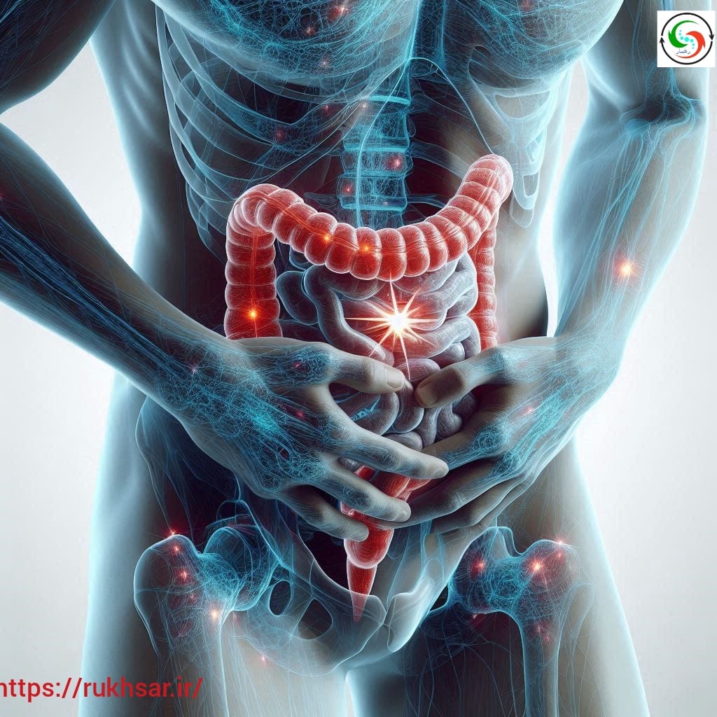 سندروم روده تحریک پذیر